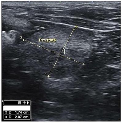 Assessment of the utility of platelet indices to diagnose clinical benign prostatic hyperplasia in dogs